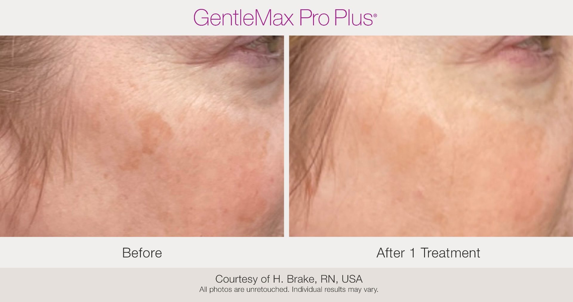 Candela melasma and pigmentation treatment at Maison Zolara