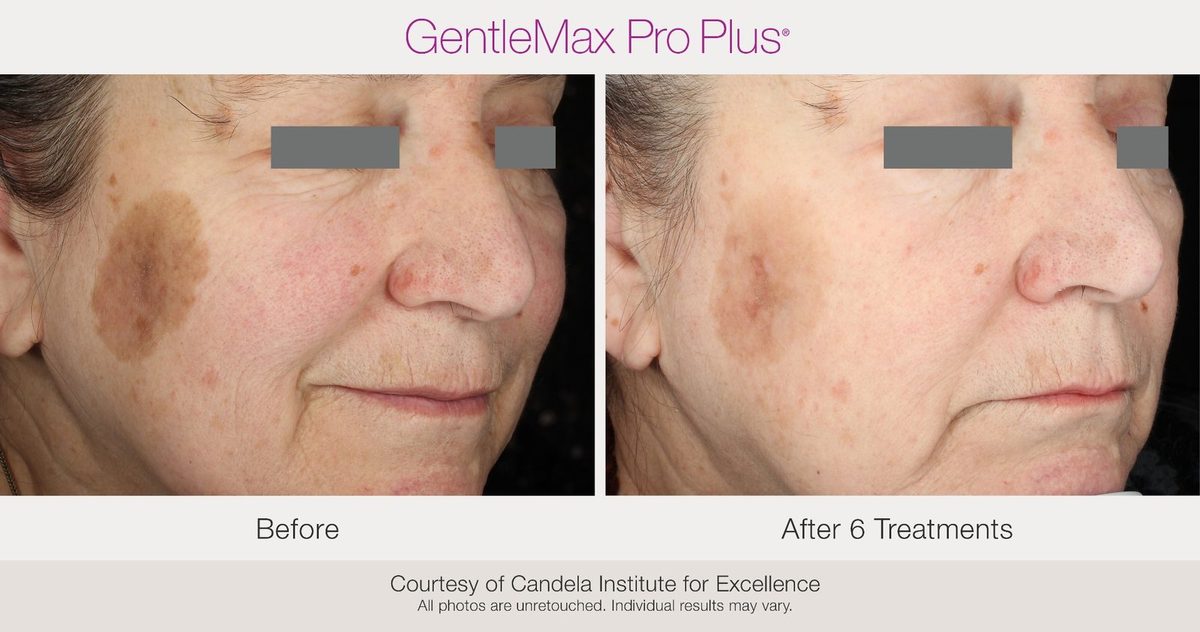 Before and after pigmentation treatment results after 6 sessions